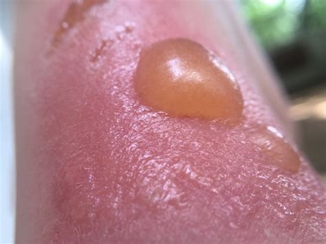 Sunburn Blisters: Symptoms, Treatments, and Complications